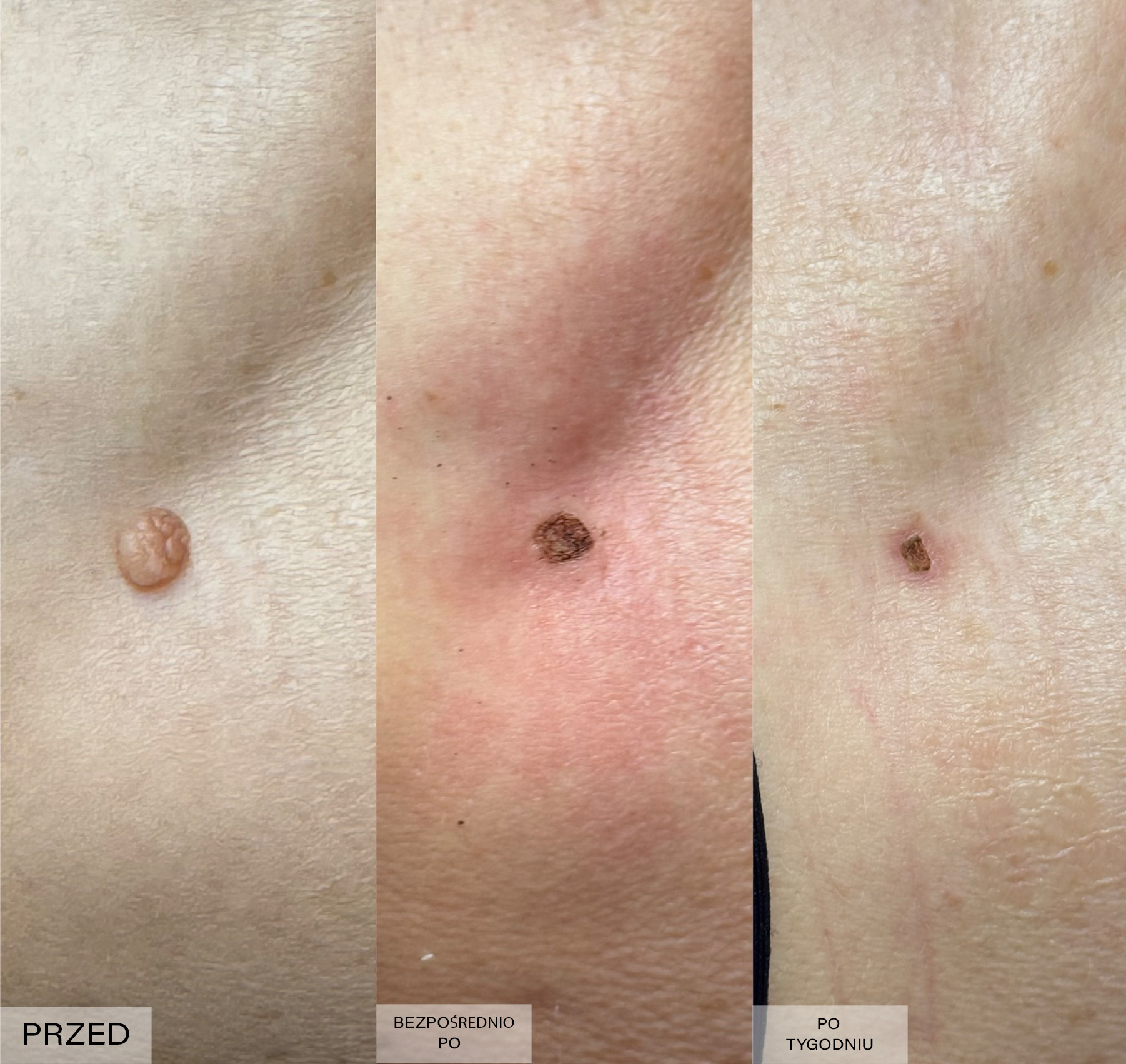 Efekt elektrokoagulacji